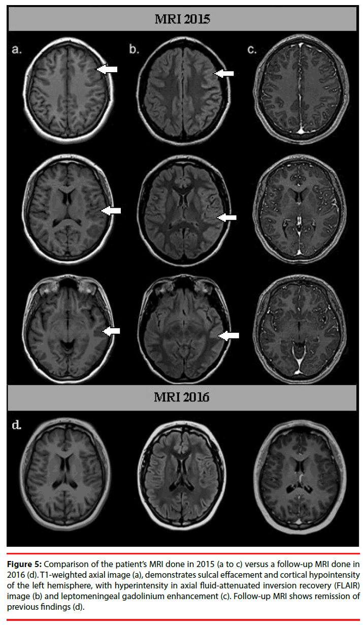 neuropsychiatry-sulcal-effacement