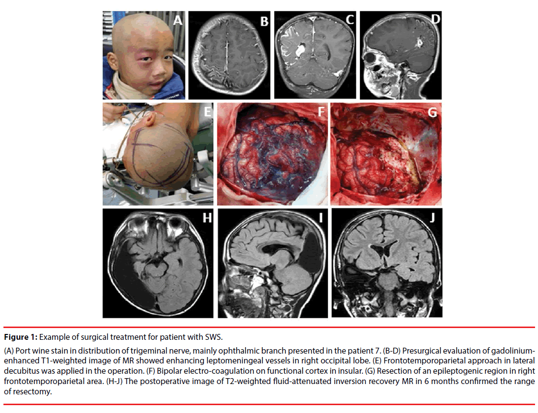 neuropsychiatry-surgical-treatment