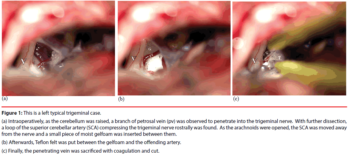 neuropsychiatry-typical-trigeminal-case