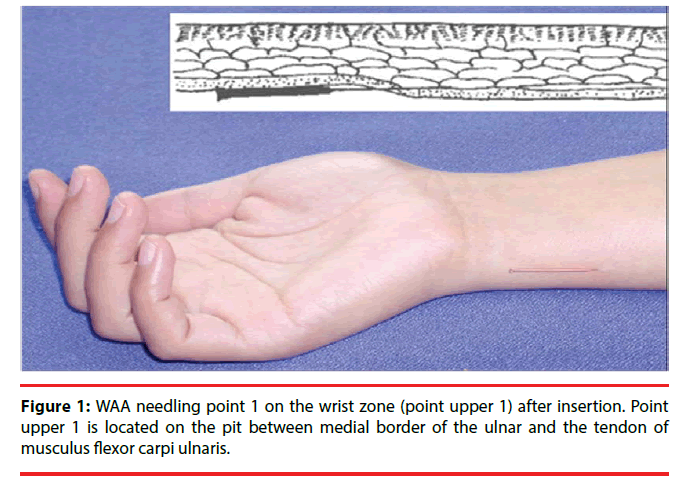 neuropsychiatry-wrist-zone